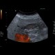 Gallstones, cholecystolithiasis, sludge, twinkling artifact: US - Ultrasound